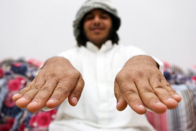 Khalifa Al Yamahi shows his burnt hands after he and his cousin fell into a pit of chemicals that left them needing several operations. Pawan Singh / The National 