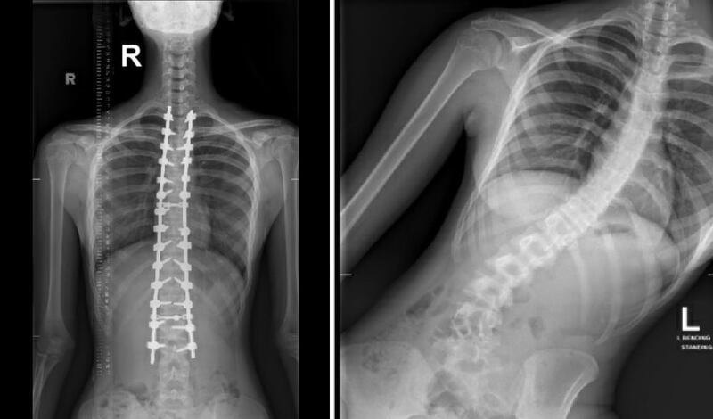 Hoor Elnayed suffered from scoliosis, which causes a curvature of the spine. All pictures courtesy of Sheikh Shakhbout Medical City