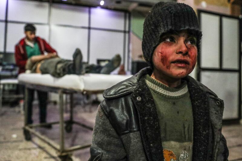 A child injured in shelling seen in a hospital in Douma, Eastern Ghouta on March 3, 2018. Mohammed Badra / EPA