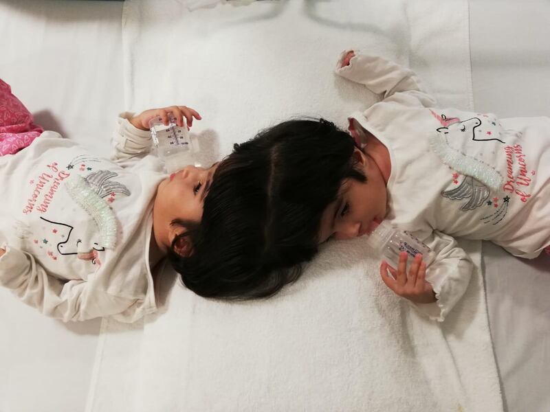 Craniopagus twins Marwa and Safa. Great Ormond Street Hospital