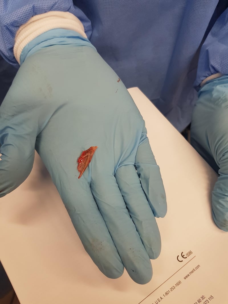 Doctors at the Cleveland Clinic Abu Dhabi removed a fish bone from a girl's lungs, who was complaining of breathing problems.