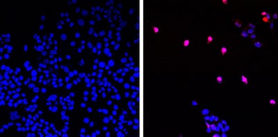Image of untreated cancer cells (left) and cancer cells treated with AOH1996 (right) undergoing programmed cell death (violet). PA
