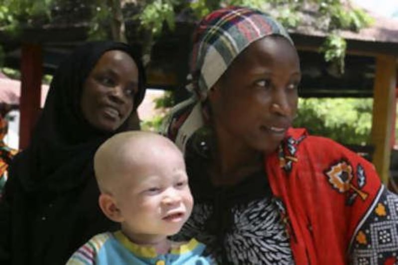 A woman holds her albino child in Dar es Salaam, where 30 murders have taken place this year.