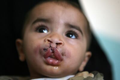 SAHAB, JORDAN: A Child is treated by his mother after he was operated for the Cleft-lip by the doctors of Operation Smile on June 16, 2008 in Totanji hospital in Sahab, Jordan. (Salah Malkawi/ The National)