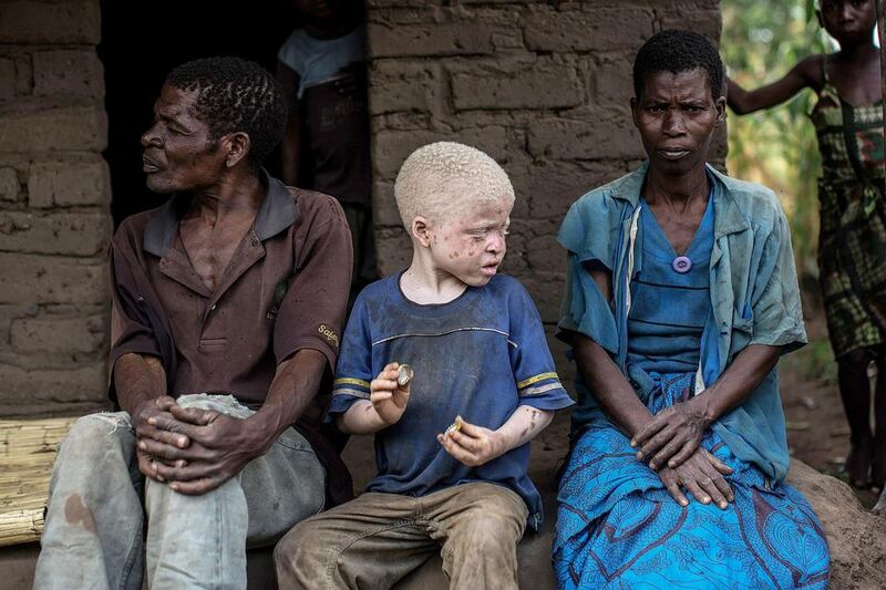 A file photo of an albino child sitting between his parents in the traditional authority area of Nkole, Machinga district. A Malawi court has banned witchdoctors from operating in the impoverished southern African country following a spate of albino killings linked to witchcraft, according to a court ruling seen on June 2, 2016.  AFP / Gianluigi Guercia/AFP