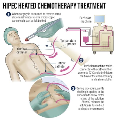 The new Hyperthermic Intraperitoneal Chemotherapy treatment for abdominal cancer carried out at Cleveland Clinic Abu Dhabi. Roy Cooper / The National 