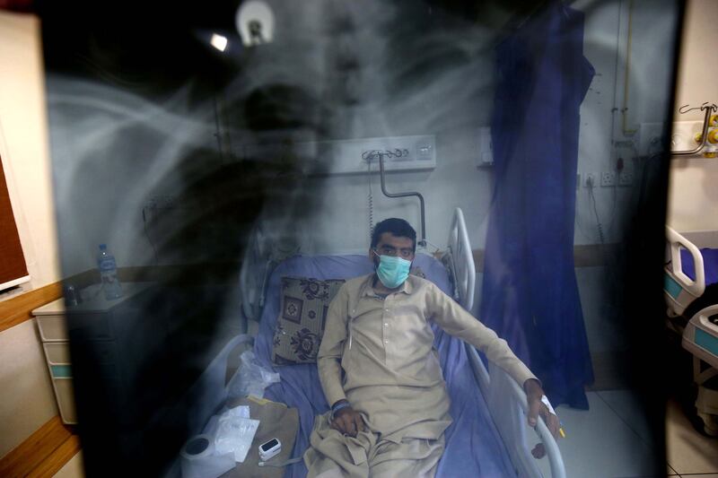 A patient suffering from TB receives medical treatment at a hospital in Peshawar, Pakistan.  EPA