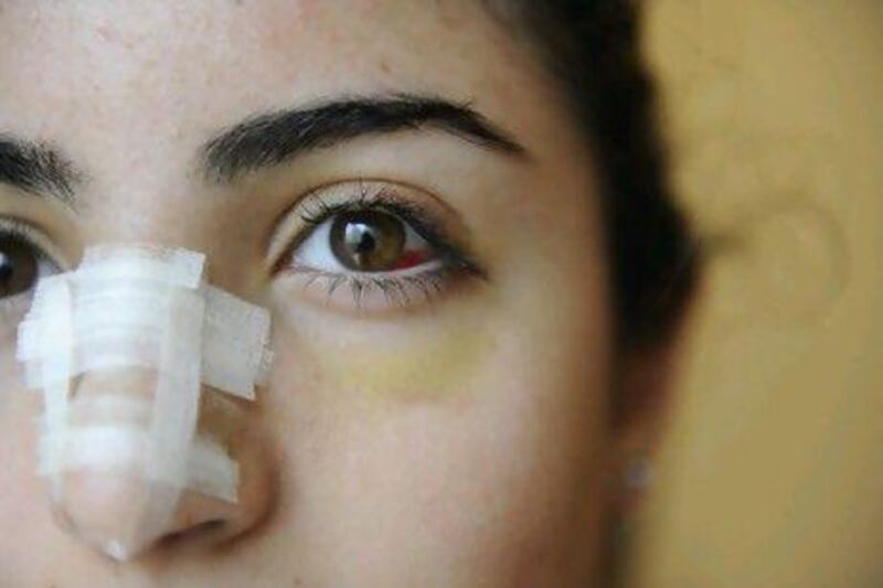 One teen says she decided to have it after seeing all her schoolfriends sporting plasters on their noses.