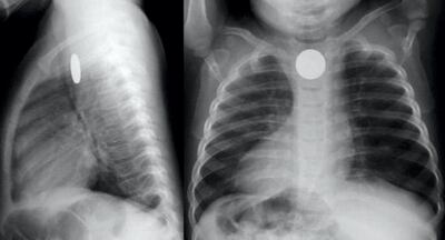 An X-ray shows a coin lodged in the throat of a child who was treated at Sheikh Khalifa Medical City. 