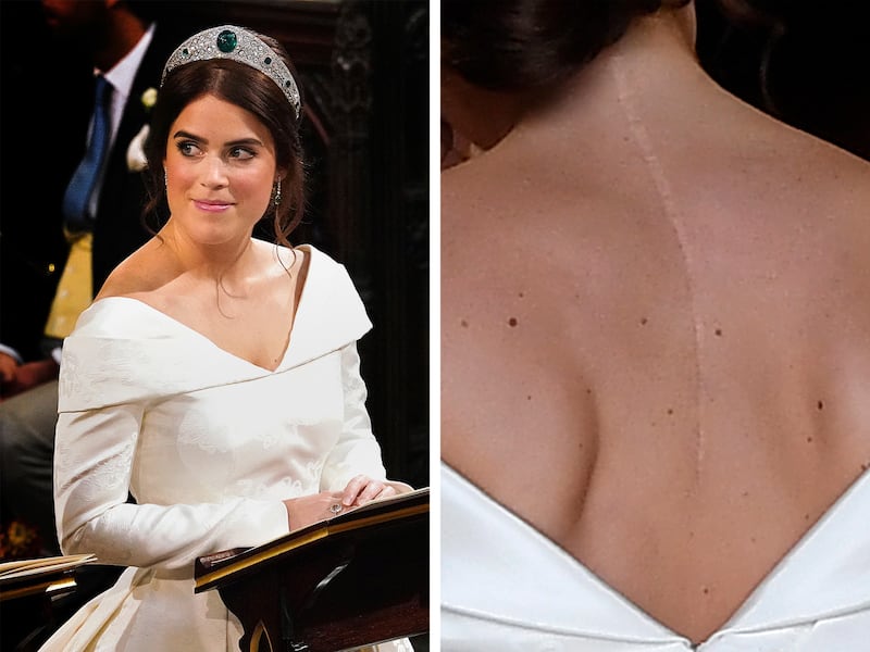 Britain's Princess Eugenie has a scar on her back following a procedure to correct the curvature of her spine. Getty