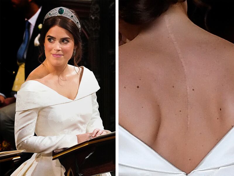 Britain's Princess Eugenie has a scar on her back following a procedure to correct the curvature of her spine. Getty
