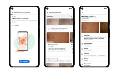 Google AI tool Derm Assist will help patients identify skin conditions. Courtesy Google 