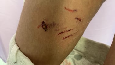 Dog bite wounds sustained after a dog attack in Fujairah last year. Photo: Supplied