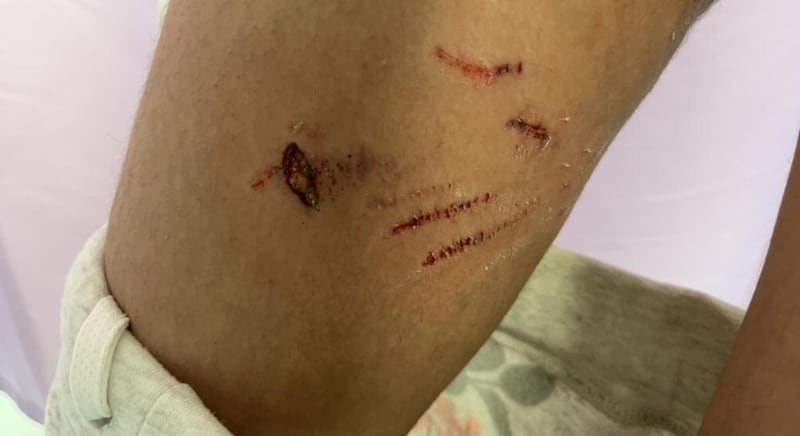 Dog bite wounds sustained after a dog attack in Fujairah last year. Photo: Supplied