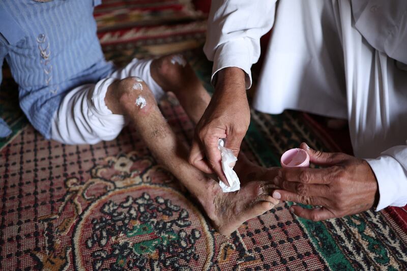 Kazem Hussain applies ointment to the legs of his niece, Zahraa Ali Hassan, 7, to treat a skin problem the family says is caused by contaminated water