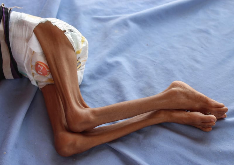 EDITORS NOTE: Graphic content / TOPSHOT - A Yemeni child suffering from malnutrition lies on a bed at a hospital in the northern district of Abs in the northwestern Hajjah province on September 19, 2018. The three-year conflict between Yemen's Saudi-backed government and Huthi rebels linked to Iran has pushed the already impoverished country to the brink of famine, leaving many unable to afford food and water, with a total of 5.2 million children at risk of starvation according to the Britain-based NGO Save the Children. / AFP / Essa Ahmed
