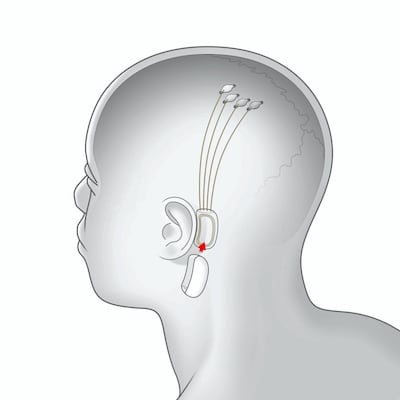 An illustration of what Neuralink's human-computer interface is to look like. Photo: Neuralink