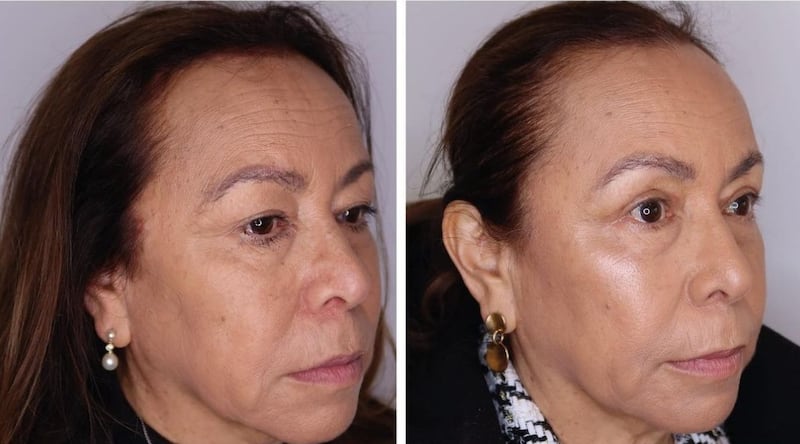 Before and after from an upper eyelid surgery blepharoplast