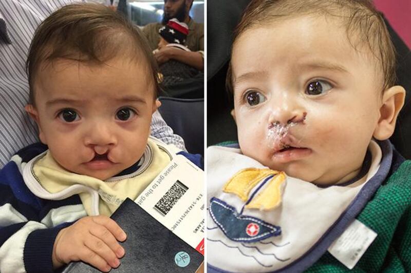 Ibrahim, whose surgery lasted two hours, was the second Syrian child to be sent to Kenya by Oasis Hospital. Courtesy Oasis Hospital