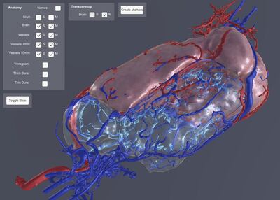 A 3D model of the twins intertwined brains. Great Ormond Street Hospital