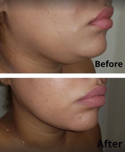 New skin tightening techniques are being used to remove stubborn double chins. Photo: Dr Matteo Vigo
