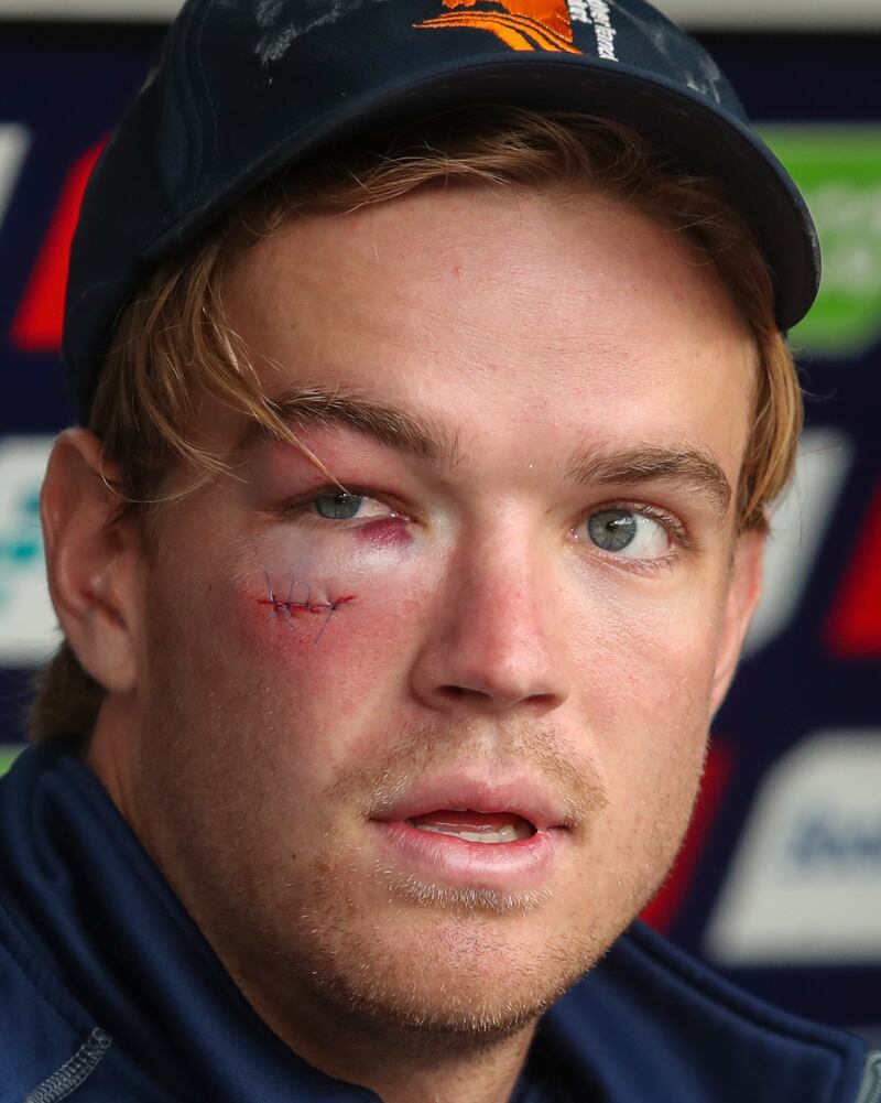 Netherlands' Bas de Leede after receiving stitches in a cut after he was hit while batting. AP