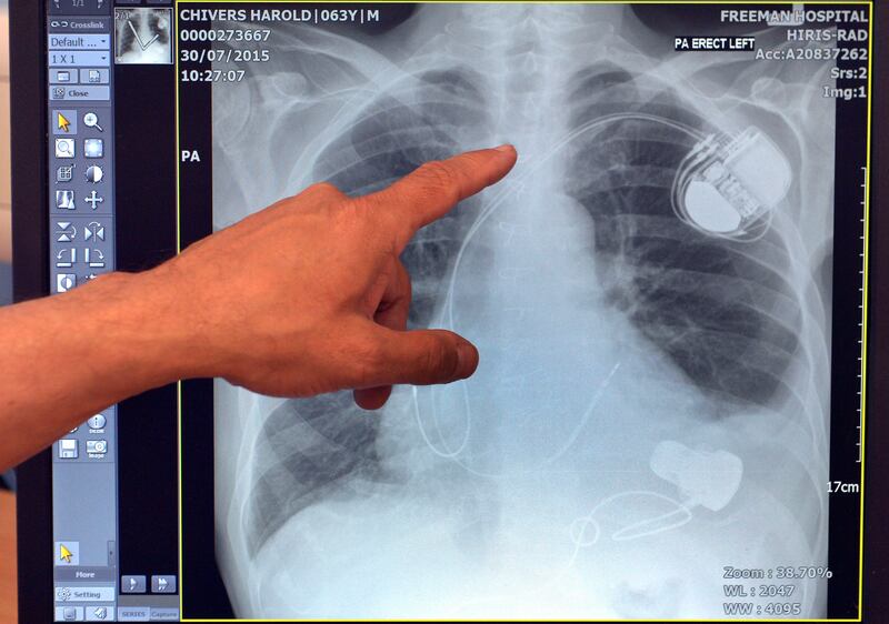 Doctors at the Freeman Hospital in Newcastle, UK, examine an X-ray image showing a Miniaturized Ventricular Assist Device heart pump in the chest of Harold Chivers, after he became the first person in the world to have the device fitted. PA Images