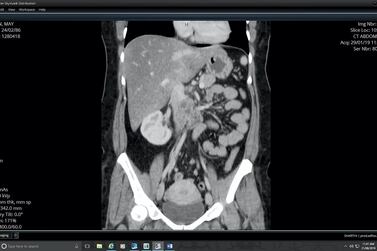 A scan shows Mai Mohammed's tumour, near her abdomen. Courtesy Mafraq Hospital