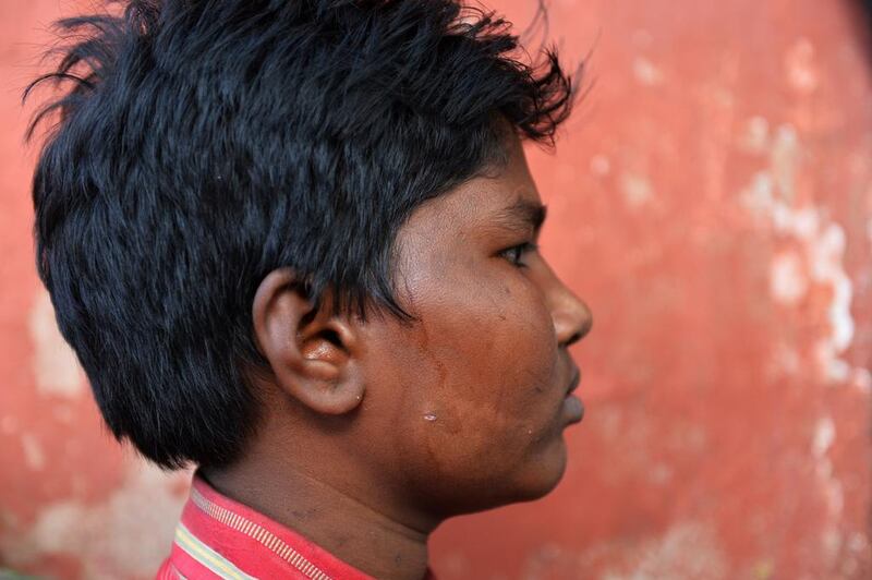 Pawan, 14, diagnosed with the early signs of leprosy with white patches on his face, poses for a photograph in the colony.