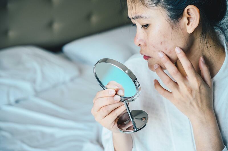 Close up of Asian woman worry about her face when she saw the problem of acne and scar by the mini mirror. Getty Images