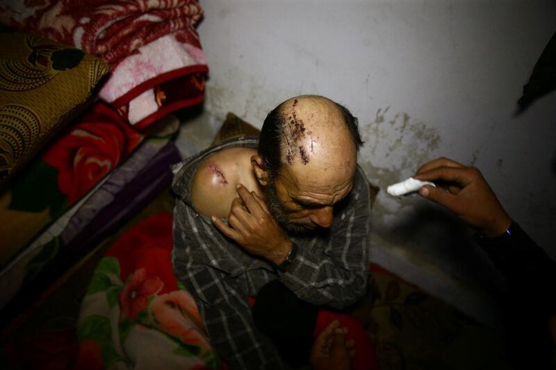 A man in a shelter in Douma shows wounds sustained during government bombing and clashes with rebels in the Eastern Ghouta region of Syria. Bassam Khabieh / Reuters