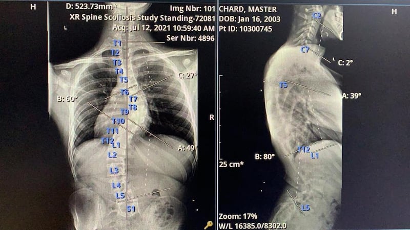 X-ray images of Chard's scoliosis. His active lifestyle has helped him to avoid surgery. Photo: Levi Chard