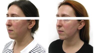 A before-and-after image of a woman who underwent jawline sculpting with a filler, which can change the structure of the face and potentially cause issues at passport control. Photo: The Soni Clinic