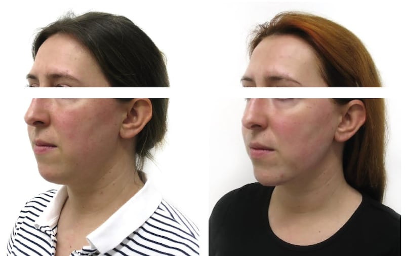 Jawline sculpting before and after on female patient with filler