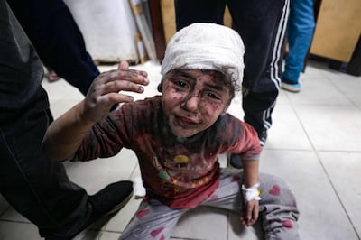 A Palestinian child injured in Israeli bombardment at the Al Najjar hospital in Rafah in the southern Gaza Strip on March 24, 2024. AFP