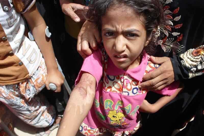 Zaineb, 11, who is in a camp for displaced Iraqis who fled Fallujah, shows the scars on her arm from being injured in a coalition air strike. Florian Neuhof for The National