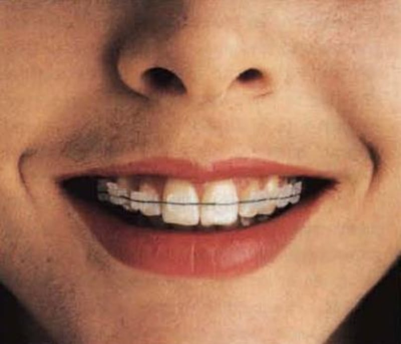 Nasa’s technology transfer programme helped one company create invisible braces. In 1989, It worked with Ceradyne Inc to develop translucent polycrustalline alumina, a ceramic that is stronger than steel. Nasa originally used it as a protection tool for infrared antennae on missile trackers. Courtesy: Nasa