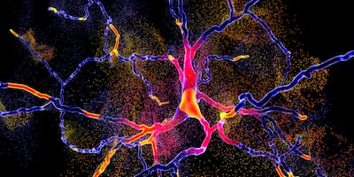A conceptual illustration of the degeneration of a dopaminergic neuron, the key step in development of Parkinson's disease. Getty Images