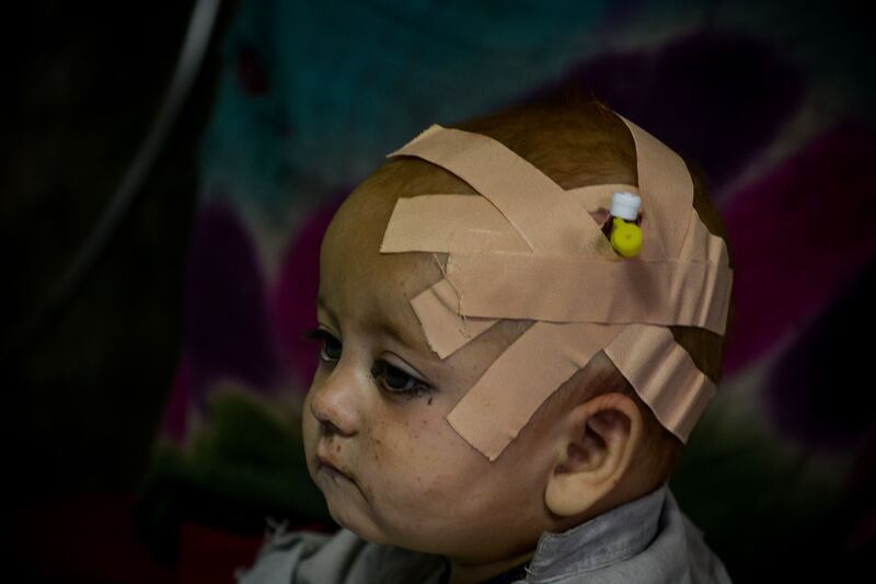 An Afghan child is treated in hospital. AFP