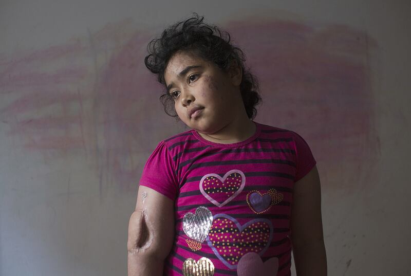 Injured Palestinian girl Yasmeen Al Bakri,11, stands in her bedroom of an apartment her grandparents are renting in the Shati refugee camp in Gaza CIty ,Gaza on February 21,2015. She was wounded in her home during an explosion by an  Israeli air strike on August 4,2014 during last summer’s war between Israel and the Hamas-controlled Gaza Strip . Five family members were killed including her mother and two of her sisters . Yasmeen was evacuated to Turkey for medical care and has been told that she has to wait until she is 18 years old for more reconstruction surgery on her arm which was also burned as well as her face and legs . Heidi Levine for The National