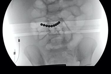 An X-ray showing nine of the magnets in the stomach of a child. If multiple magnets are swallowed they can potentially cause dangerous tears to the intestine.