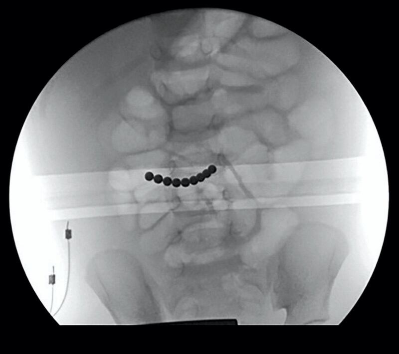 An X-ray showing nine of the magnets in the stomach of a child. If multiple magnets are swallowed they can potentially cause dangerous tears to the intestine.