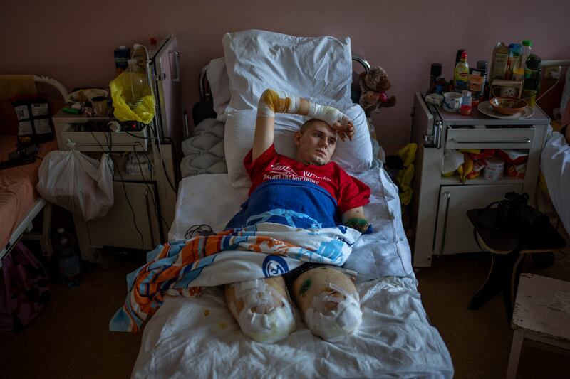 Anton Gladun lies on his bed at the Third City Hospital in Cherkasy, Ukraine, on Thursday, May 5. AP