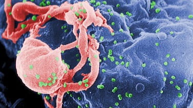 Scientists have used gene-editing technology called CRISPR-Cas to remove HIV from cells. AP