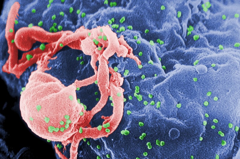 This undated photo provided by the Centers for Disease Control and Prevention shows a scanning electron micrograph of multiple round bumps of the HIV-1 virus on a cell surface. In a report released on Monday, July 24, 2017, researchers said a South African girl born with the AIDS virus has kept her infection suppressed for 8 1/2 years after stopping anti-HIV medicines _ more evidence that early treatment can occasionally cause a long remission that, if it lasts, would be a form of cure. (Cynthia Goldsmith/Centers for Disease Control and Prevention via AP)