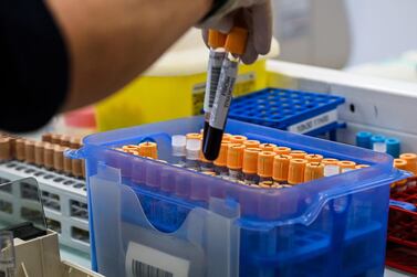 Another study has suggested that blood type may play a role in the severity of Covid-19. AFP