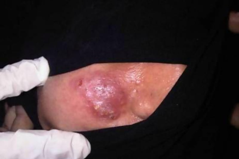 One of the victims of the three impostors who were caught offering illegal cosmetic services shows the injuries to her right cheek. Photo courtesy of Dr Ibrahim Galadari, professor of dermatology at UAE University.