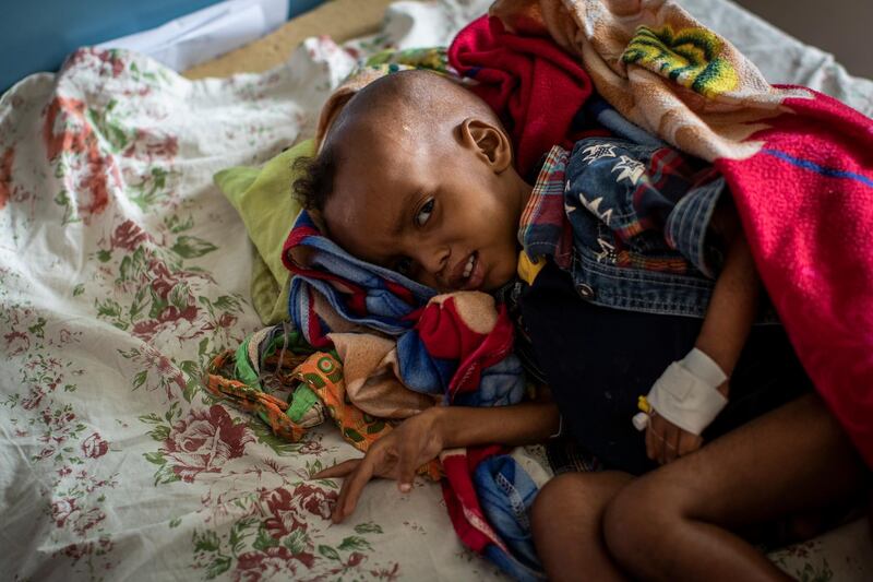 Gebre Kidan Gebrehiwet, 2, is treated for malnutrition after fleeing from the town of Abi Adi with his mother, Abeba Tesfay, at the Ayder Referral Hospital in Mekele, in the Tigray region of northern Ethiopia. AP Photo