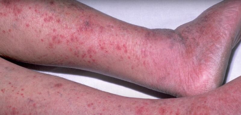 A widespread rash is one of the symptoms of sepsis and the associated condition purpura fulminans. The rash will not disappear if pressed with a glass. Lesions and necrosis - the dying of skin and tissue - may follow if not quickly treated. Photo: NHS