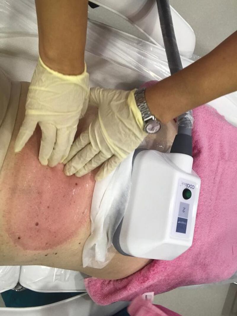 Dr Abeer Sawwaf of Icon Clinic in Abu Dhabi massages out Ann Marie McQueen's belly after the CoolTech handpiece has been removed. A second handpiece is still attached to the lower belly. Photo credit: Ann Marie McQueen